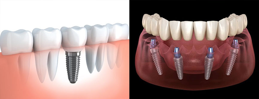 Dental Implant in Gandhinagar