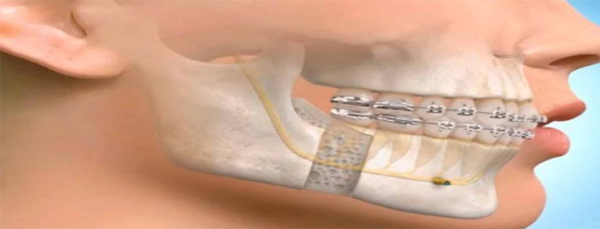 Treatment of Jaw Fracture in gandhinagar