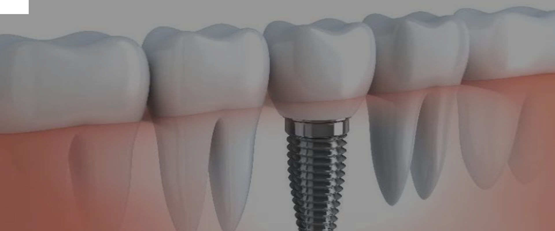 root canal treatment in Gandhinagar